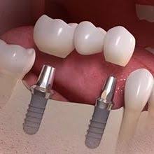 Náhrada tří zubů pomocí zubních implantátů